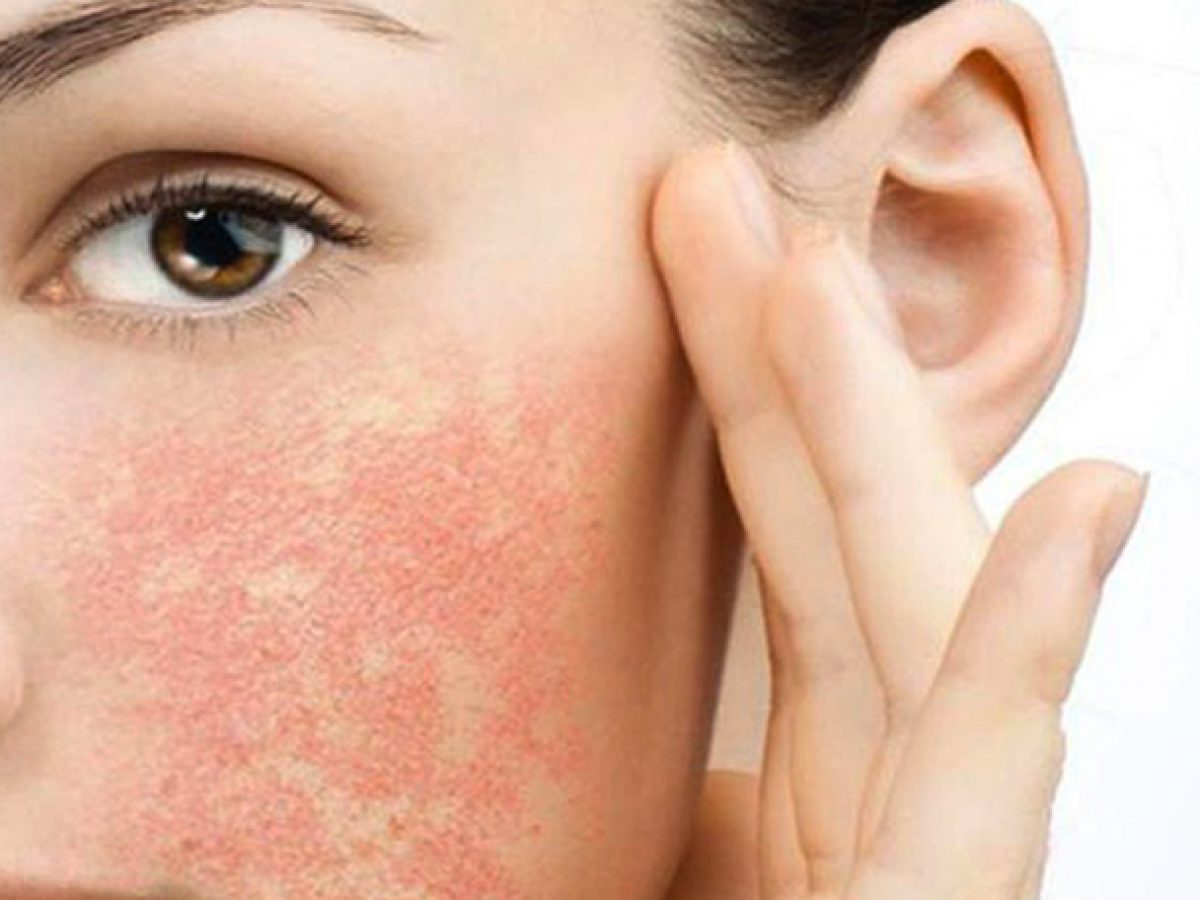 Dị ứng mỹ phẩm 1 Dị ứng mỹ phẩm