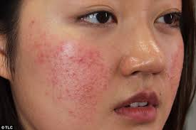 Dị ứng mỹ phẩm 2 Di ung my pham Nguyen nhan va cach dieu tri hieu qua